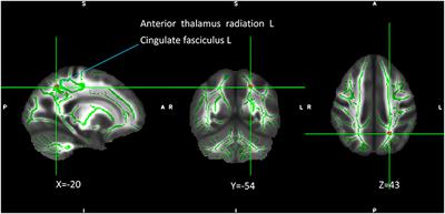 Effect of SIRT1 on white matter neural network in adolescent patients with depression